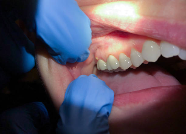 Best Emergency Dental Services for Seniors in North Manchester, IN