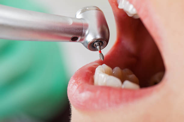 Best Emergency Dentist for Knocked-Out Tooth in North Manchester, IN